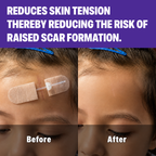 Wound Skin Closure Kit