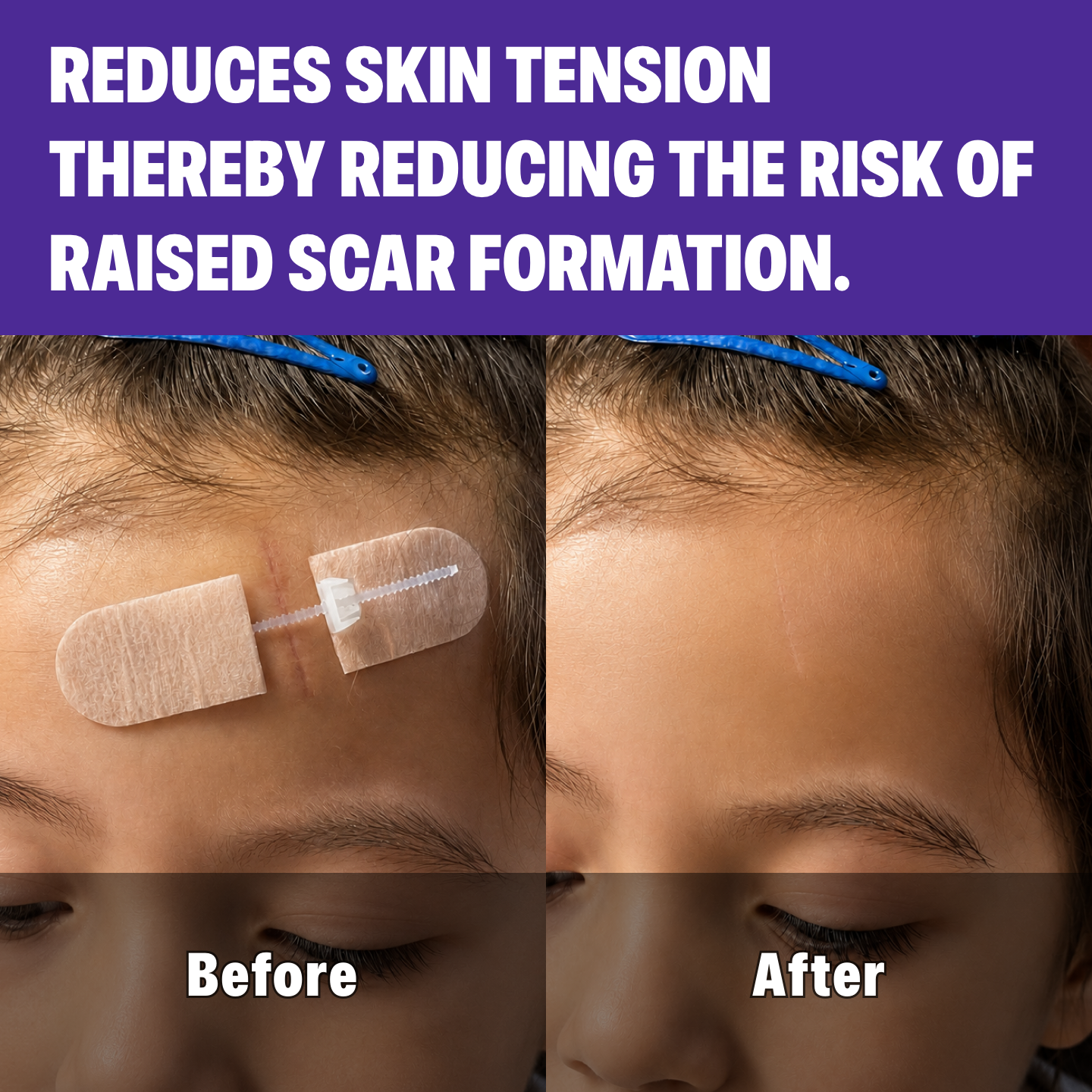 Wound Skin Closure Kit