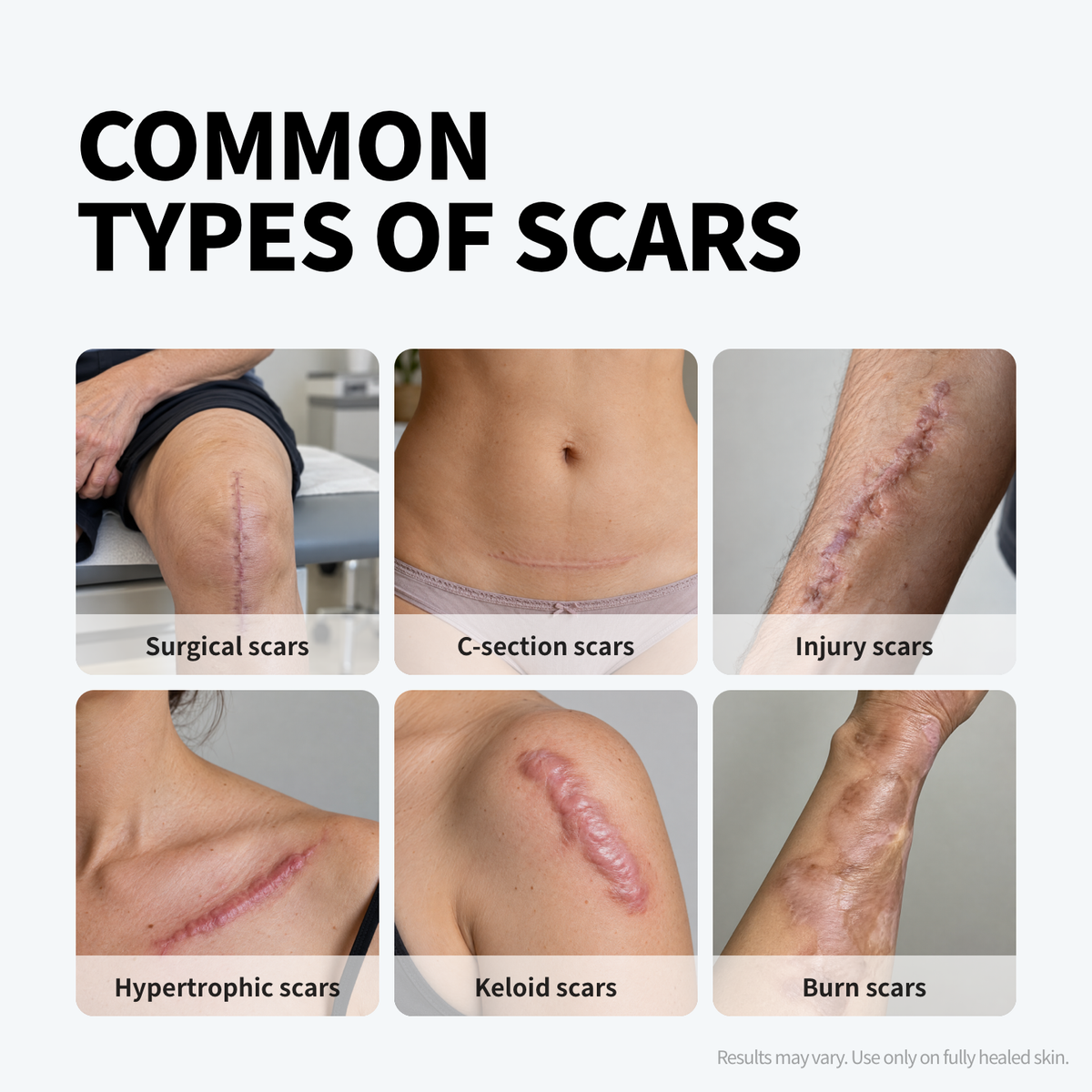 Silicone Scar Gel